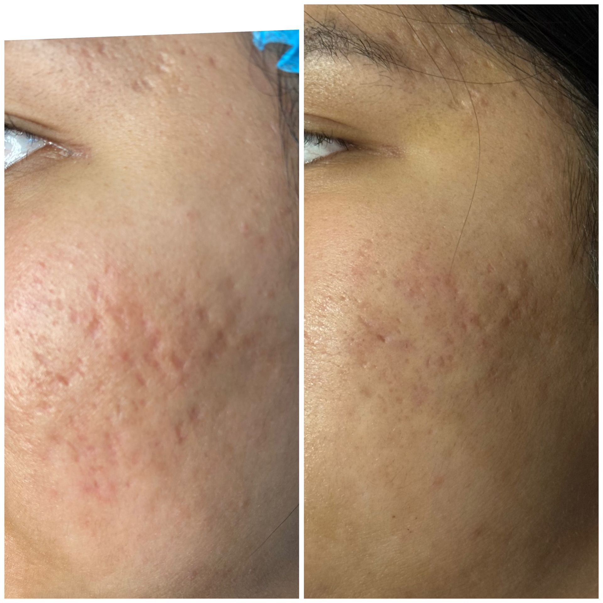 Acne Scar Revision after treatment