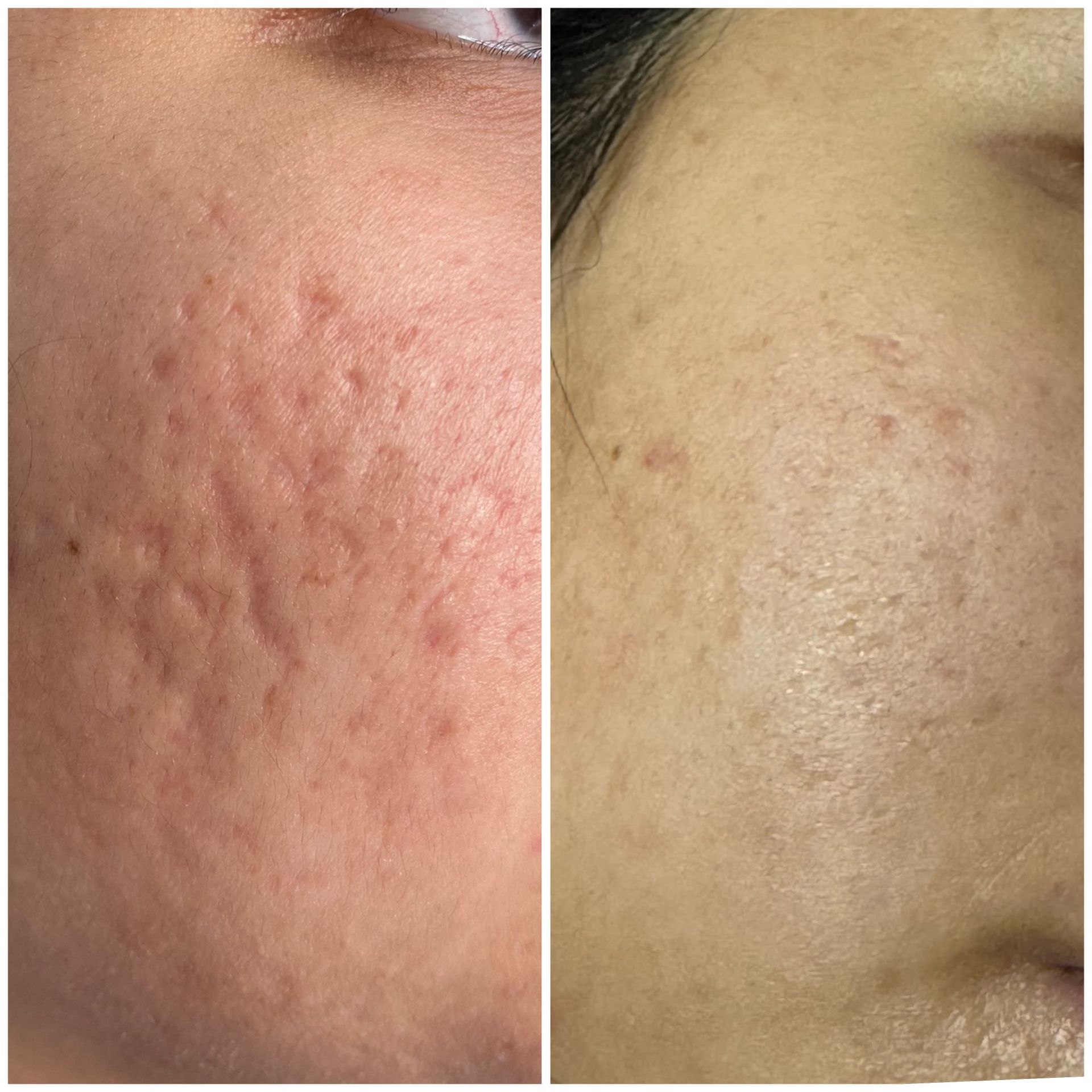 Acne Scar Revision before treatment