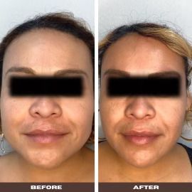 Facial Contouring after treatment