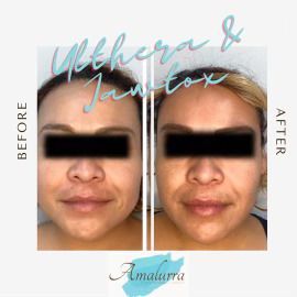 Facial Contouring before treatment
