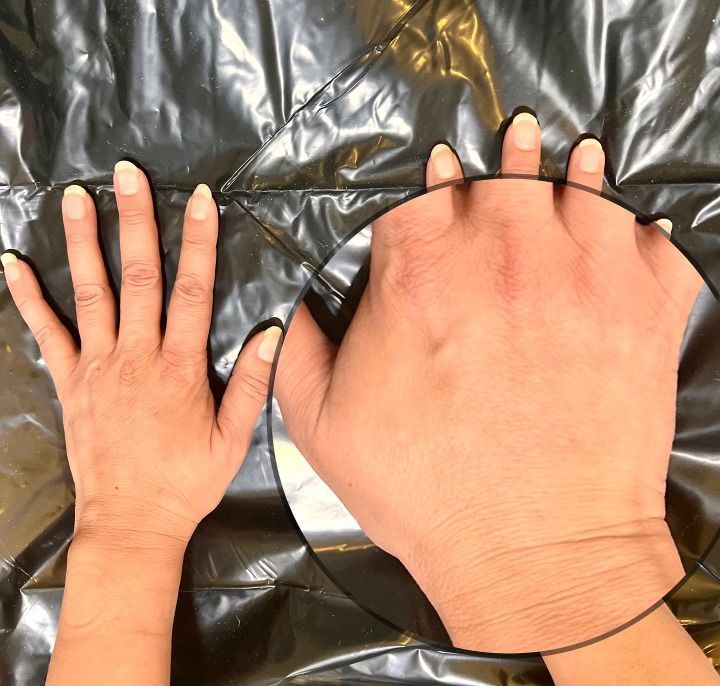 Hand Rejuvenation after treatment