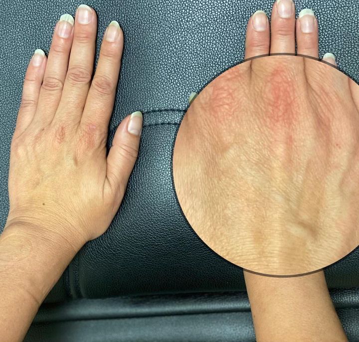 Hand Rejuvenation before treatment