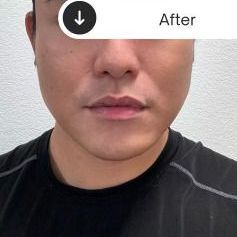 Jaw & Chin Contouring after treatment