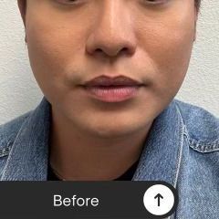 Jaw & Chin Contouring before treatment