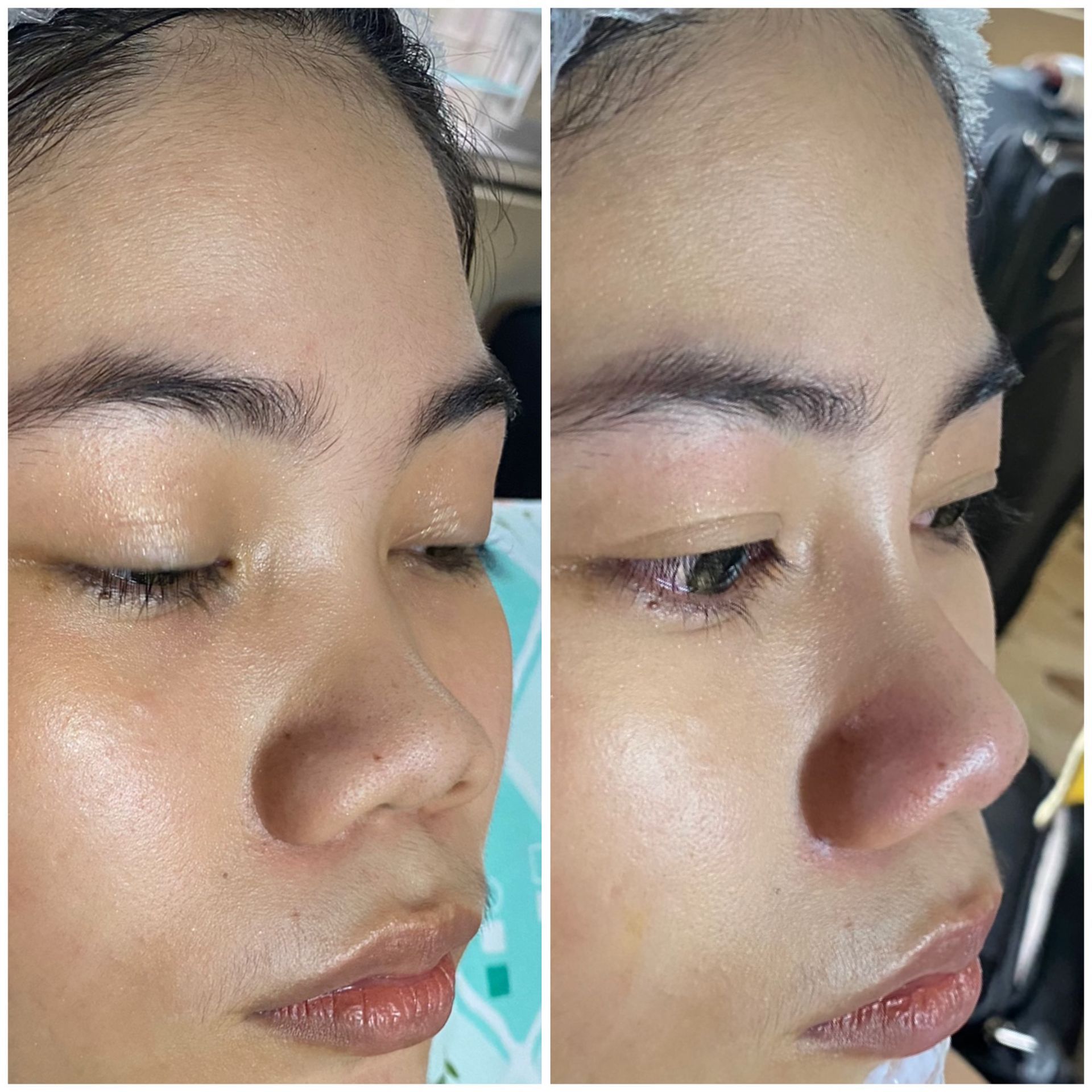 Nose Filler after treatment