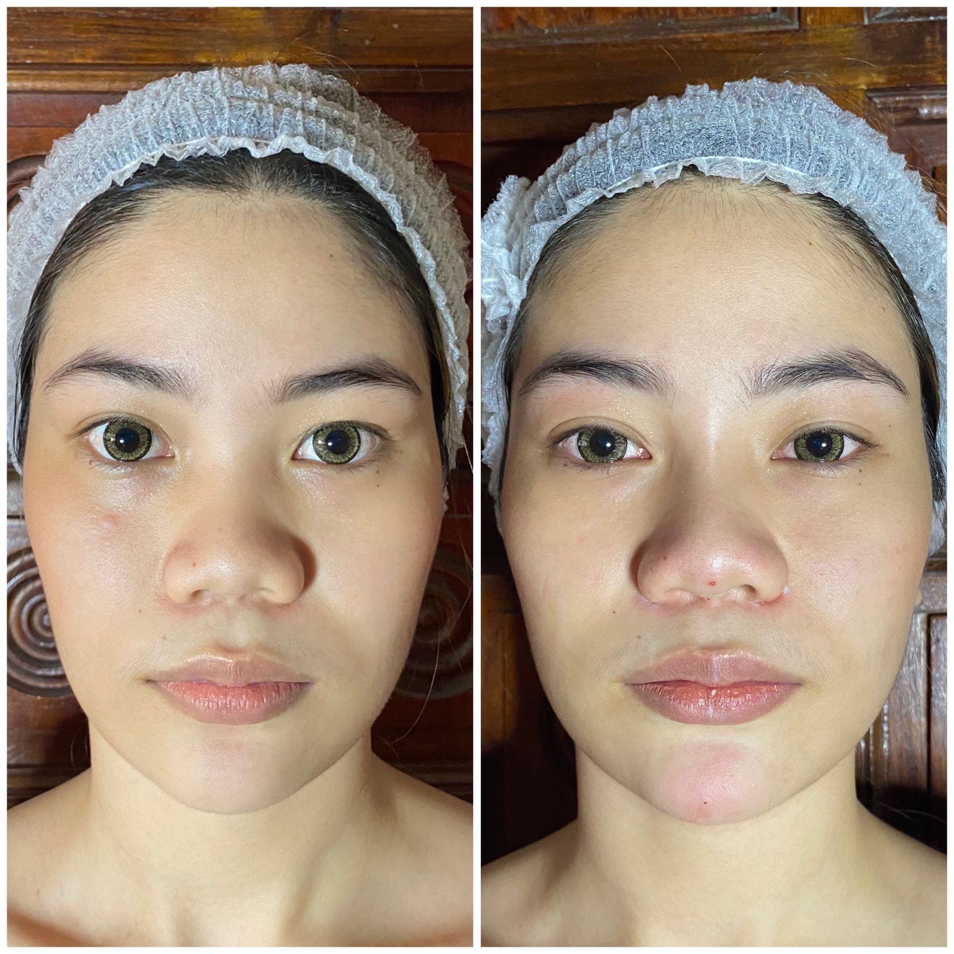 Nose Filler before treatment