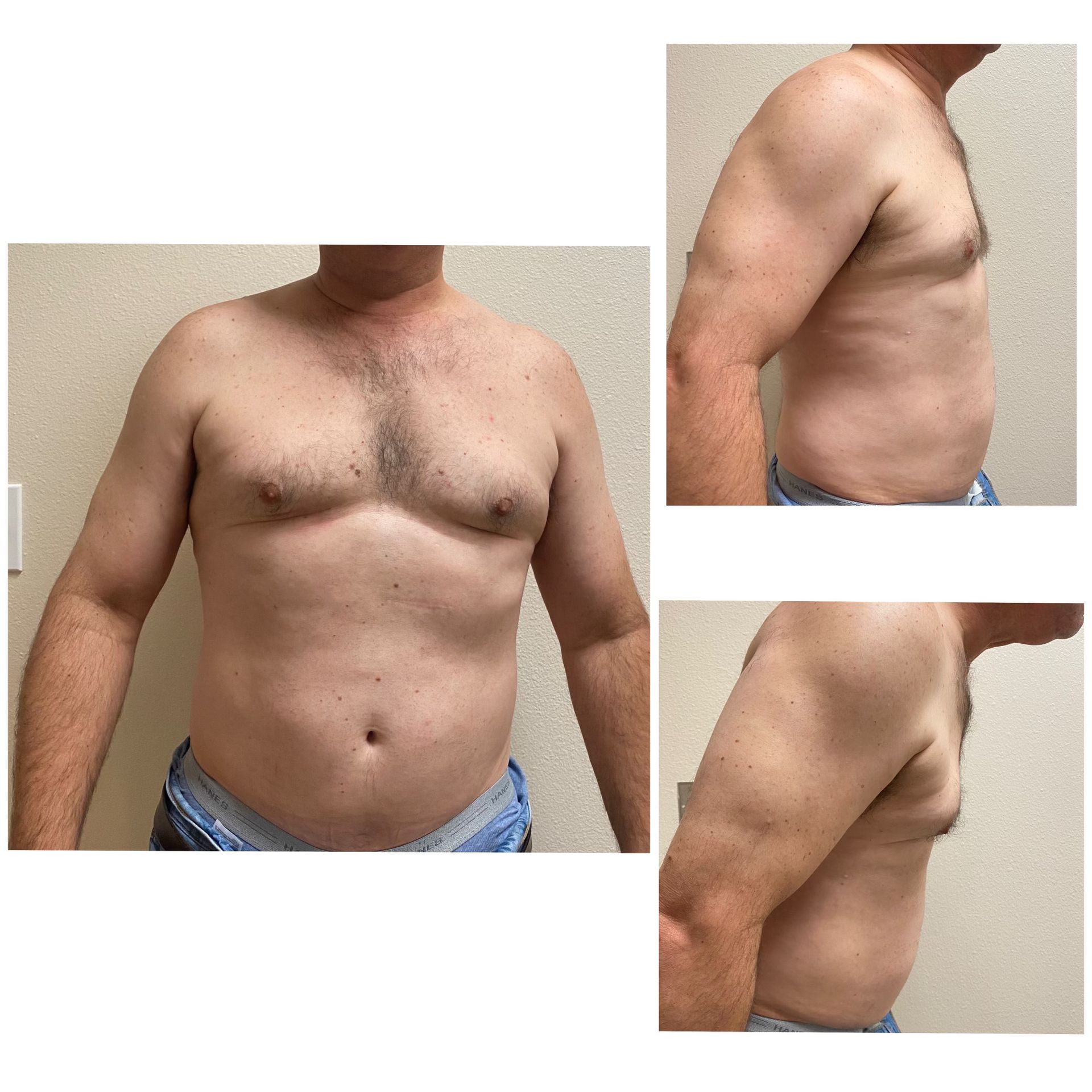 Fotona TightSculpting after treatment