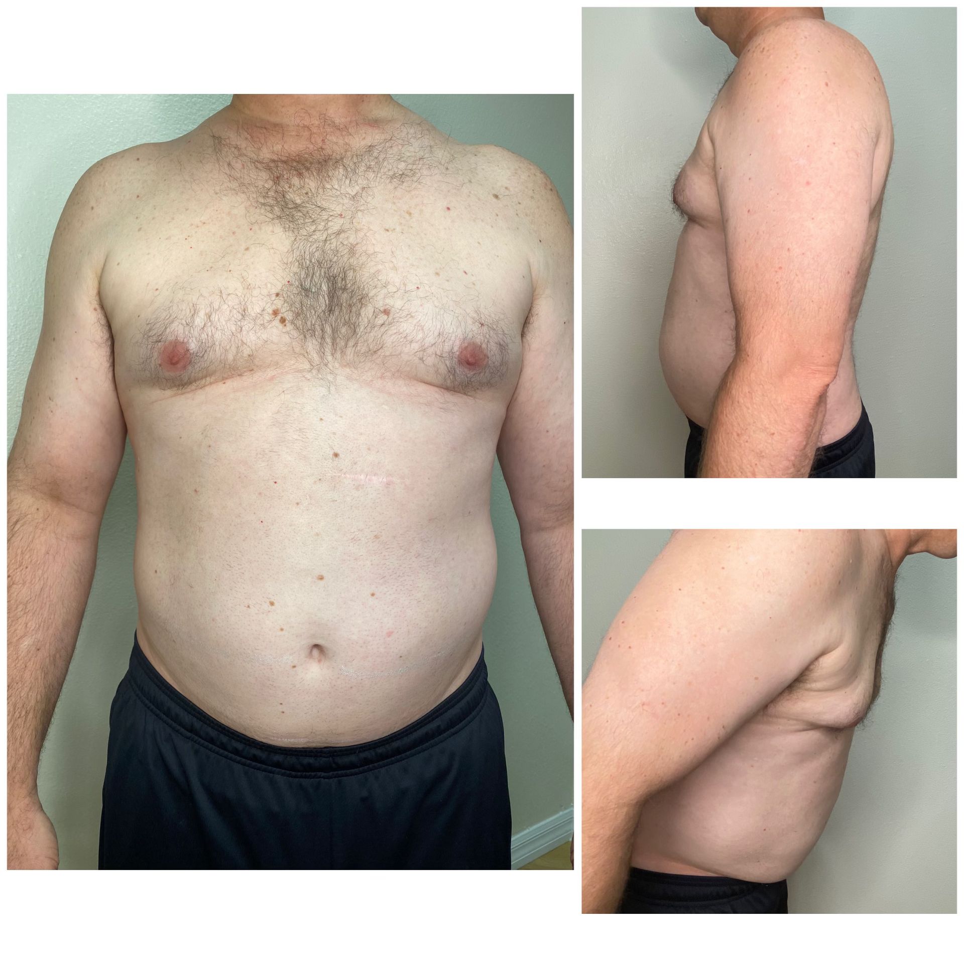 Fotona TightSculpting before treatment